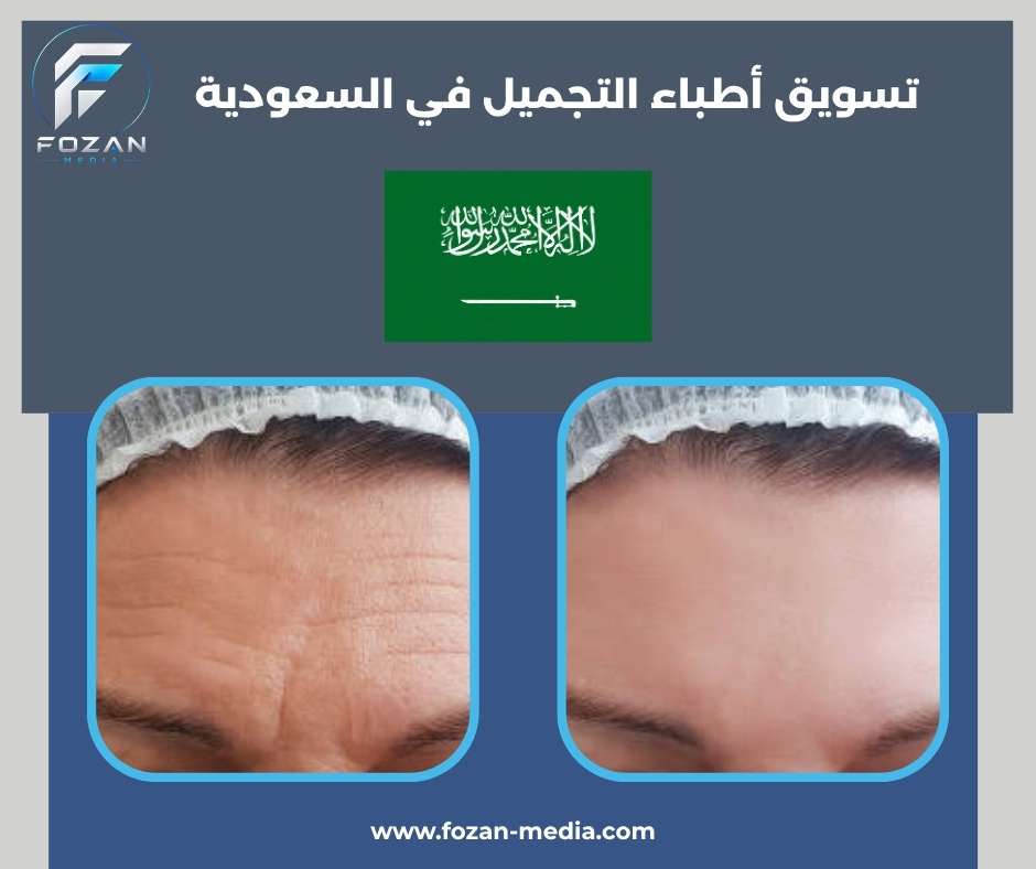 تسويق أطباء التجميل في السعودية